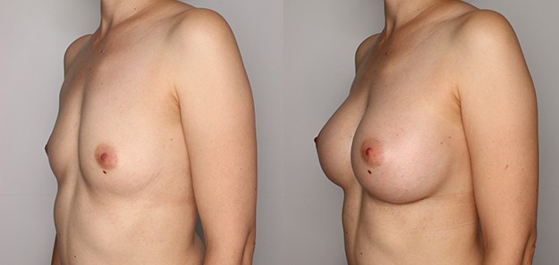 Powiększenie biustu przed i po