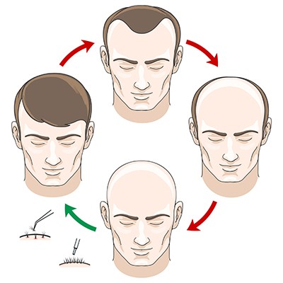 Przeszczep włosów u mężczyzn