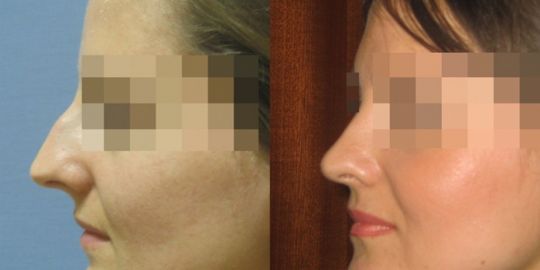 korekcja nosa - przed i po