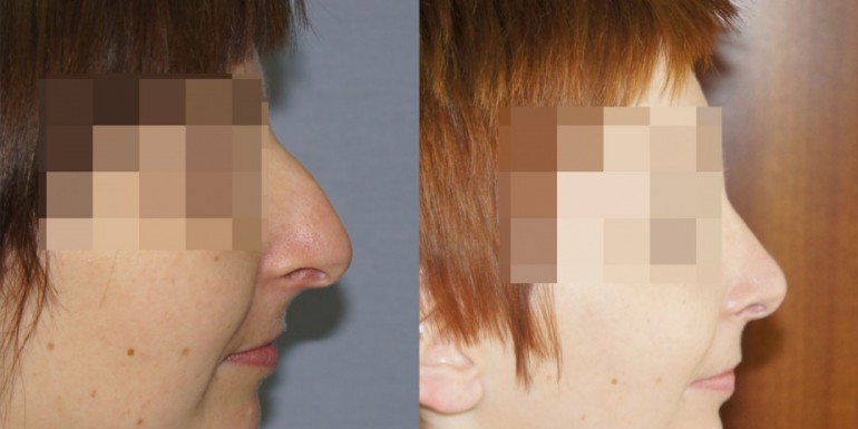 korekcja nosa - przed i po