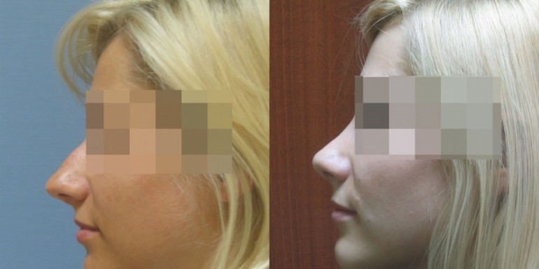 korekta nosa - przed i po