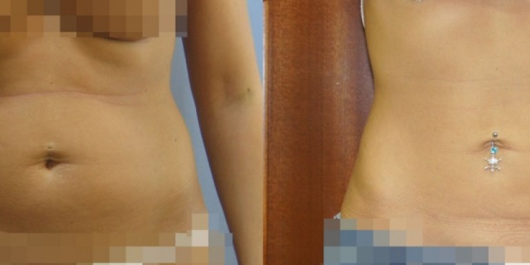 liposukcja przed i po - zabieg
