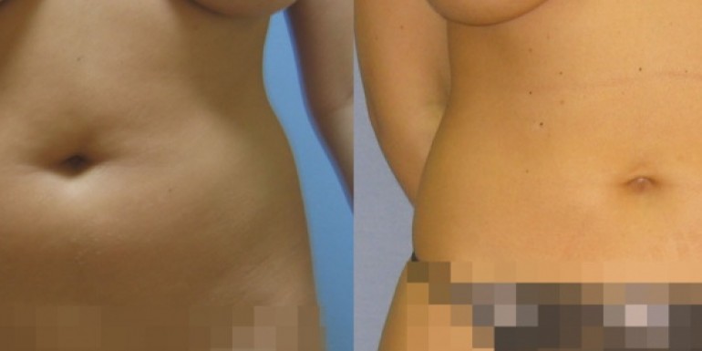 liposukcja przed i po - zabieg