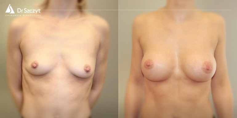 powiększenie piersi implantami przed i po - zabieg